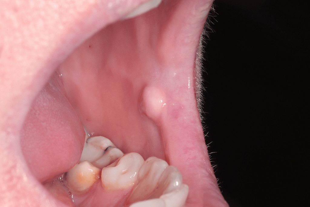 Oral Fibromas Causes, Composition, and Laser Removal at North Raleigh Perio